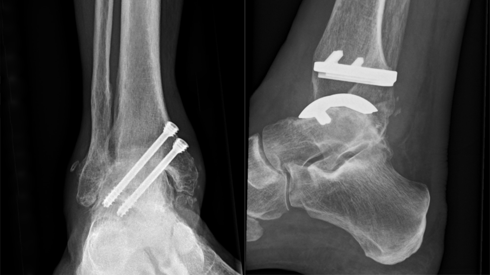 Total Ankle Replacement for Ankle Arthritis